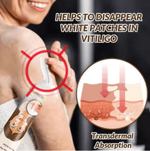 Vitiligo Removal Cream
